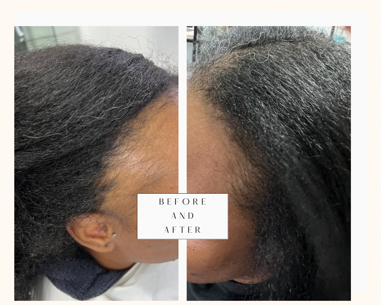 Hair Regrowth Serum